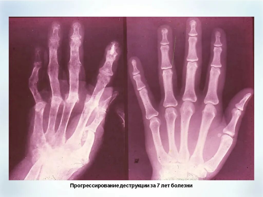 Ревматоидный артрит межфаланговых суставов. Остеоартроз межфаланговых суставов рентген. Суставные щели межфаланговых суставов. Проксимальные межфаланговые. Артрит межфаланговых