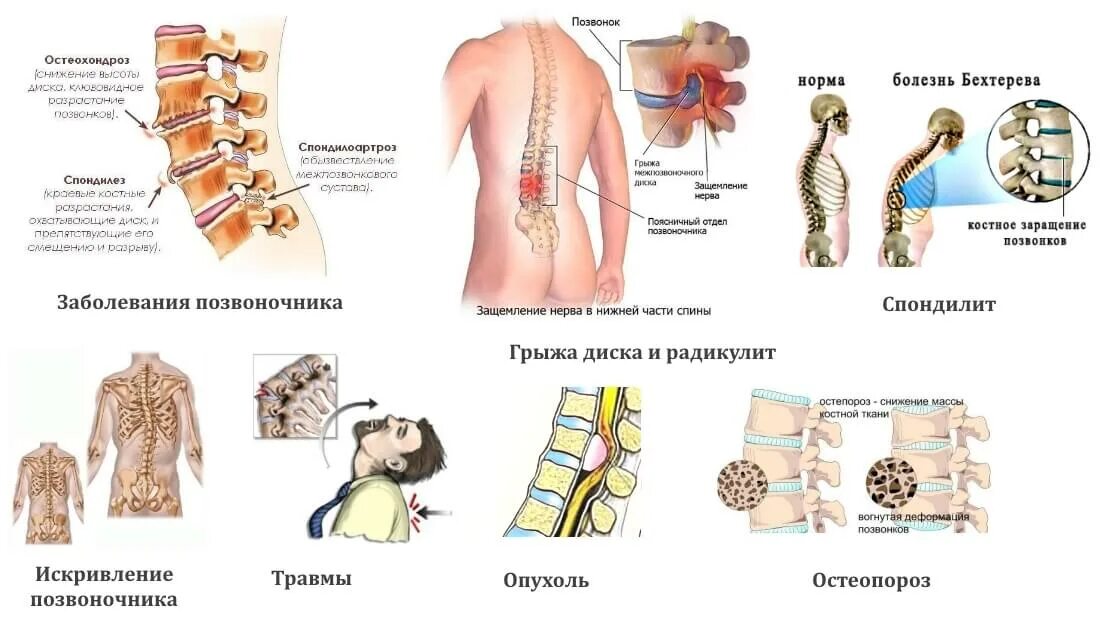 Болит поясница признаки. Заболевания позвоночника. Болезни спины. Нарушение позвоночника. Травмы и заболевания позвоночника.