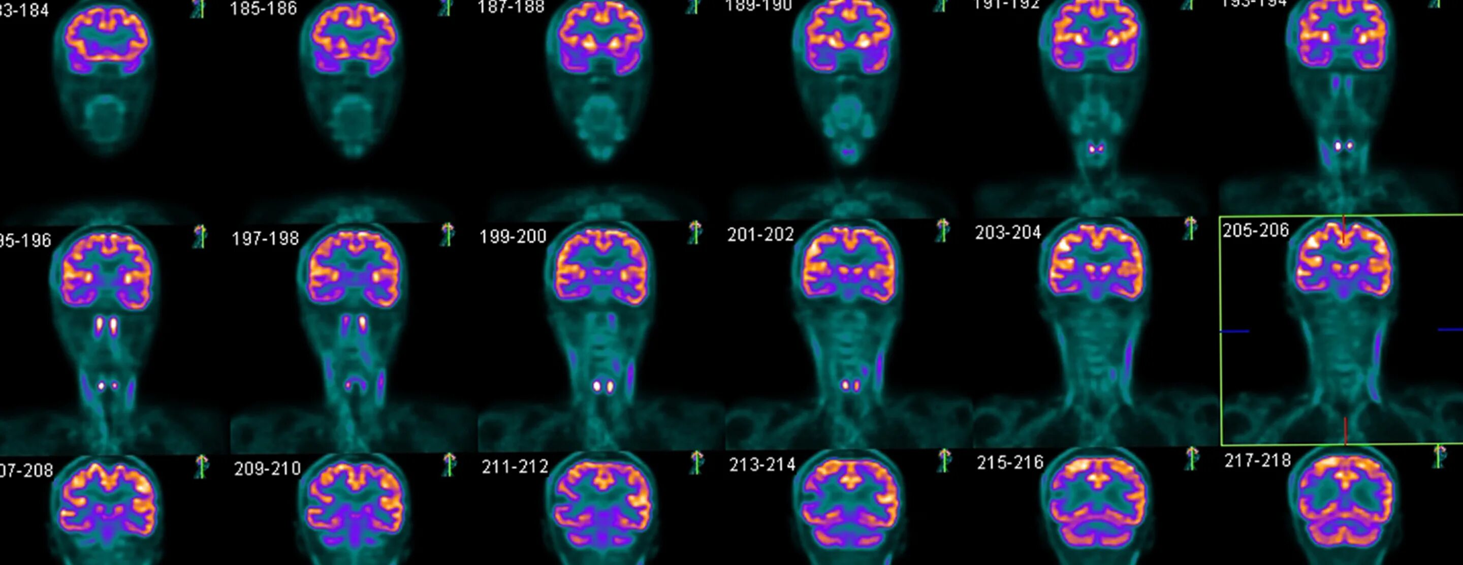 Уровень 188 brain. ПЭТ головного мозга. ПЭТ скан аутиста. ПЭТ головы. Нейрокогнитивистика.