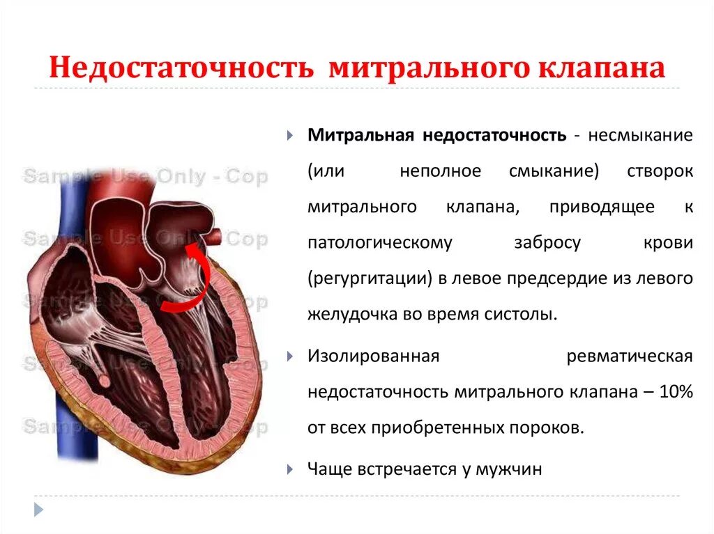 Гипертрофия митрального клапана. Митральный клапан сердца недостаточность 1 степени. Недостаточностььмирального клапана недостаточность. Пороки сердца недостаточность митрального клапана. Сердечная недостаточность митрального клапана