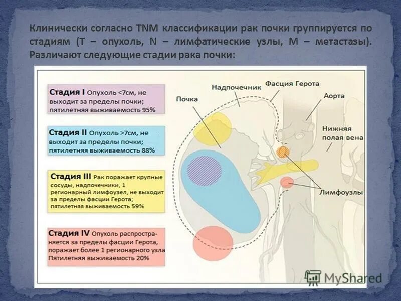4 степень рака почки