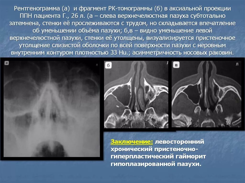 Аплазия гайморовой пазухи. Утолщение слизистой верхнечелюстной пазухи на кт. Пристеночный гиперпластический верхнечелюстной синусит. Недоразвитие верхнечелюстной пазухи. Локальное утолщение слизистой