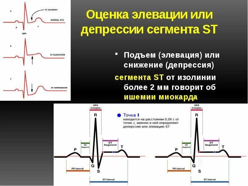 Эпизод депрессии st. Элевация сегмента St в v2. Депрессия St v3-v4. Элевация сегмента St на ЭКГ В v1-v4. Депрессия сегмента St на ЭКГ v5 v6.