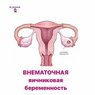 Опухоли яичников беременность