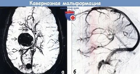 Кавернозная венозная мальформация