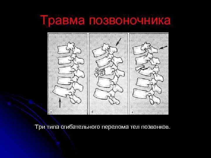 Повреждения позвоночника переломы. Сгибательный перелом тела позвонка. Сгибательный механизм травмы позвоночника. Сгибательный перелом тела позвонка рентген. Три типа сгибательного перелома тел позвонков.