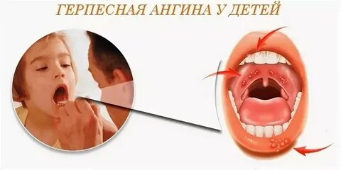 Температура горло сыпь красная