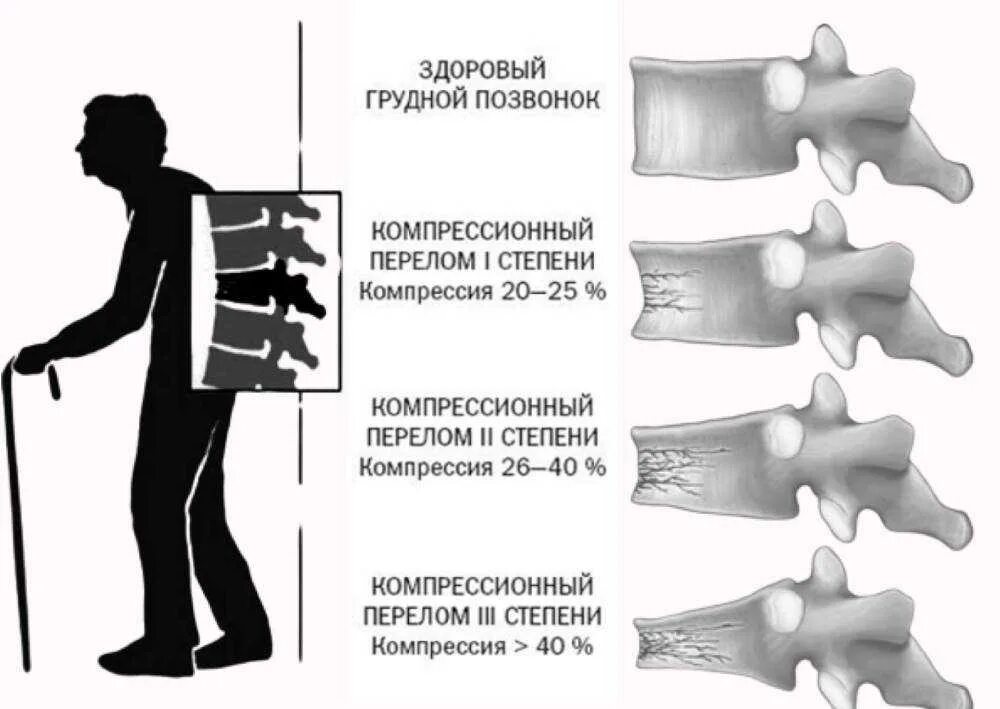 Почему нельзя сидеть при компрессионном переломе. Компрессионный перелом позвоночника l12. Клиновидный компрессионный перелом позвоночника. Компрессионный перелом т12 позвонка. Компрессионный перелом позвоночника т11.