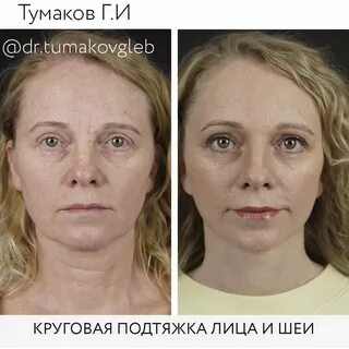 Фрау пластическая хирургия