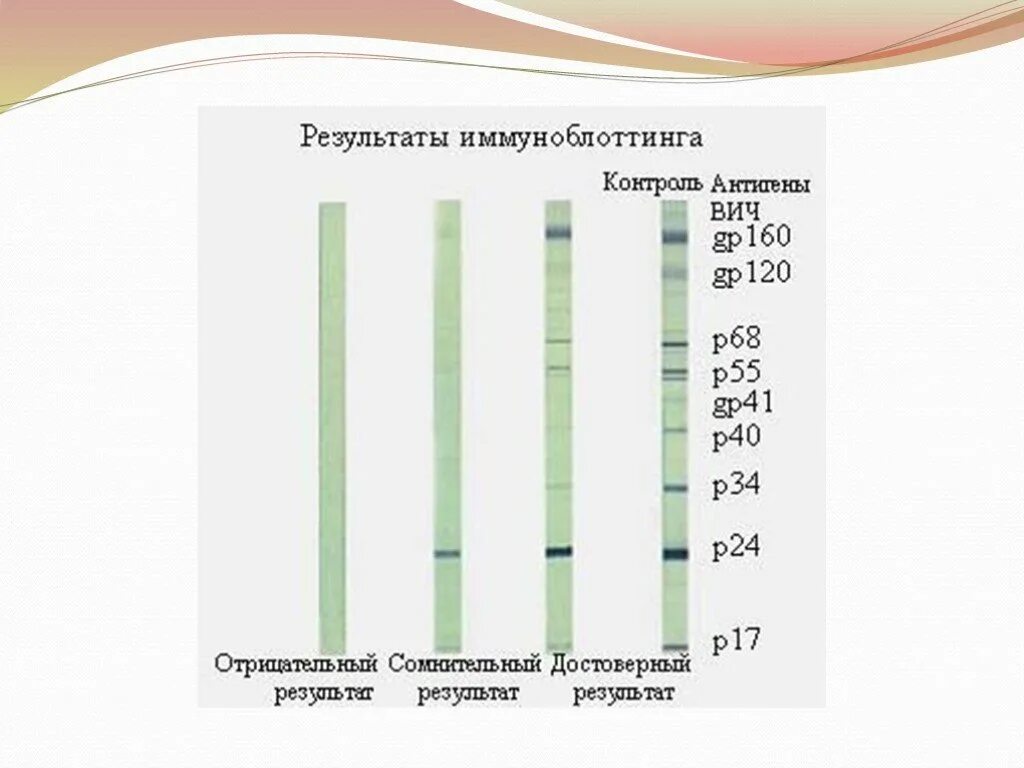 Результаты тестирования ВИЧ-инфекции с помощью иммуноблотинга.. Метод иммуноблотинга при ВИЧ-инфекции. Иммуноблоттинг интерпретация результатов. Иммуноблот ВИЧ интерпретация результатов.