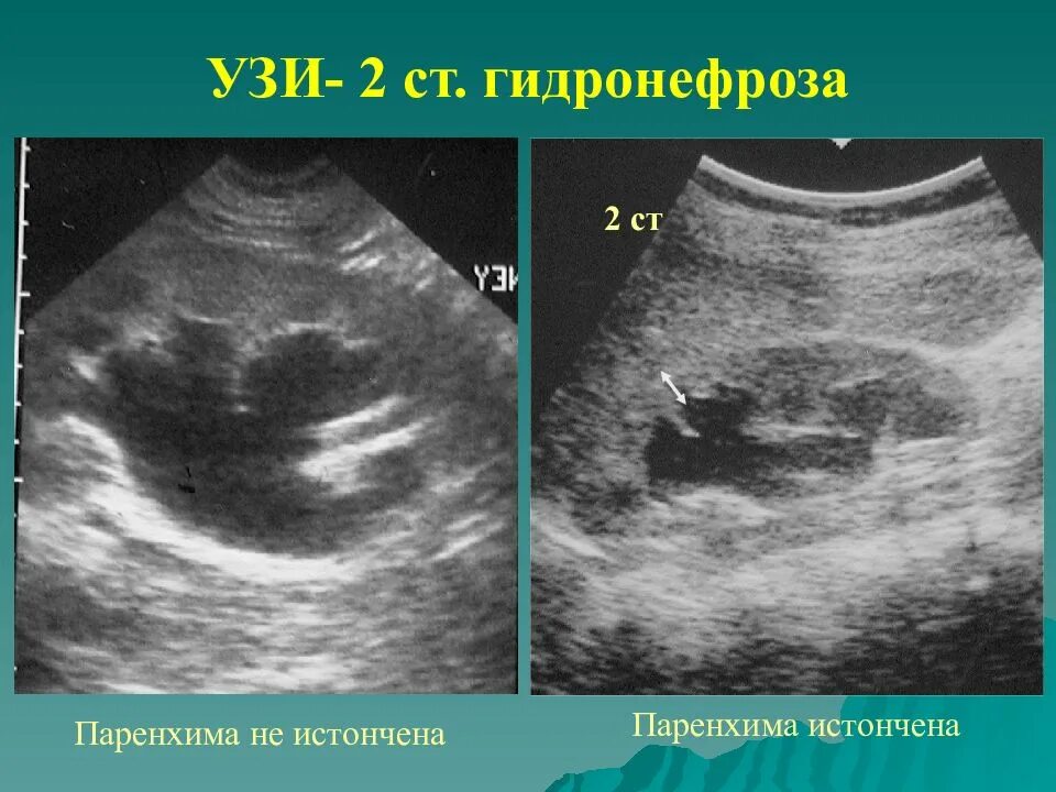 УЗИ почек гидронефроз 1ст. Расширение почечной лоханки на УЗИ. Гидронефроз почки УЗИ снимок.