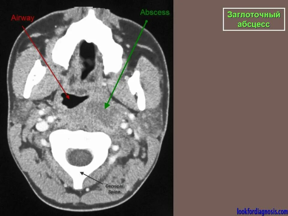 Внутриминдаликовый абсцесс. Окологлоточный абсцесс кт. Ретрофарингеальный абсцесс кт. Тонзиллогенный абсцесс. Кт миндалин