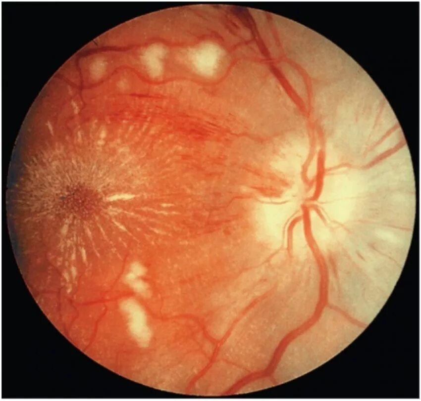 Гипертоническая ретинопатия глазное дно. Ангиоспастическая ретинопатия. Гипертоническая болезнь ретинопатии. Ангиосклероз сетчатки ou. Ангиопатия сосудов сетчатки что это