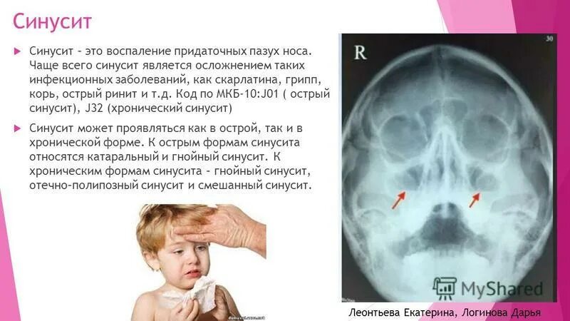 Прободение носовой перегородки. Опухоли полости носа классификация. Искривление перегородки носа мкб код 10. Международная статистическая классификация болезней. Код мкб острый риносинусит 10 у взрослых.