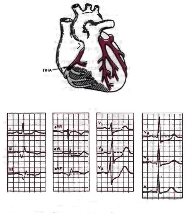 Нижняя стенка лж на ЭКГ. Инфаркт миокарда нижней стенки ЭКГ. Инфаркт миокарда задней стенки на ЭКГ. ЭКГ при заднем инфаркте миокарда. Изменение боковой стенки левого желудочка