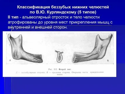 Классификация верхней челюсти