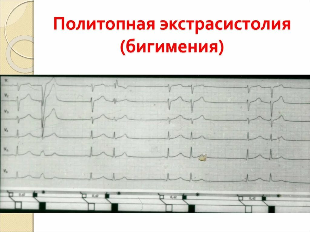 Экстрасистолия на ЭКГ. Политопные желудочковые экстрасистолы. Желудочковые экстрасистолы на ЭКГ. Политопная полиморфная желудочковая экстрасистолия. Политопные экстрасистолы