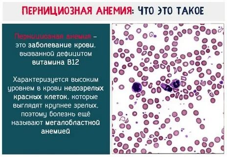 Пернициозная анемия