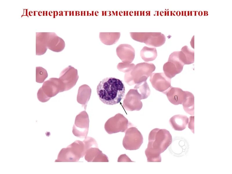 Дегенеративные изменения мазка. Дегенеративные изменения лейкоцитов. htutythfnbdystизменения лейкоцитов. дегенеративные лейкоциты это. патологические изменения лейкоцитов.