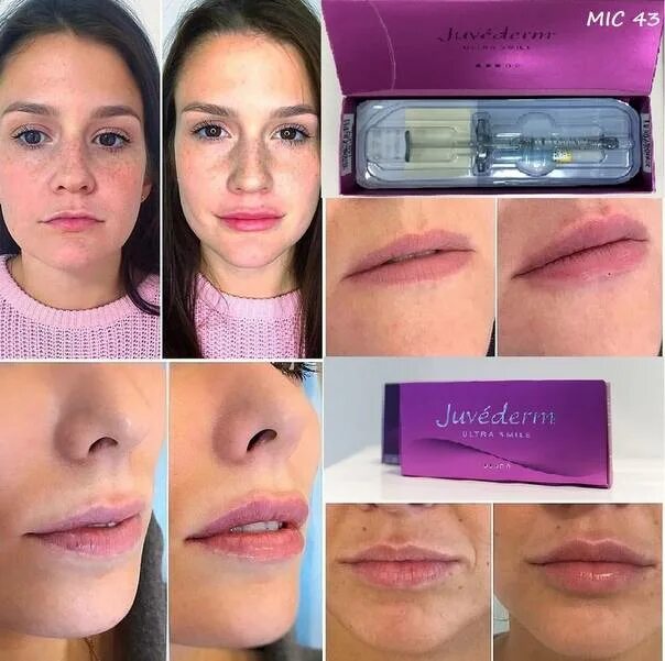 Препараты для увеличения губ. Губы инъекции увеличение. Какие препараты для увеличения губ. Корейский препарат для увеличения губ. Какие препараты для увеличения губ.