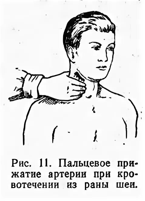 Перевязка шеи бинтом при ранении. Наложение жгута при ранении шеи. Методы остановки кровотечения сонной артерии. Ранение сонной артерии. Наложение бинтовых повязок на шею.