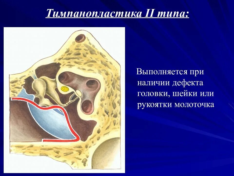 Тимпанопластика отзывы. Хронический отит операция тимпанопластика. Отосклероз барабанная перепонка. Тимпанопластика, мирингопластика.