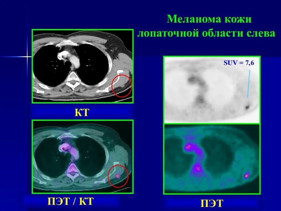 Пэт кт диагнозы. Пэт лучевая диагностика. пэт/кт метод лучевой диагностики.