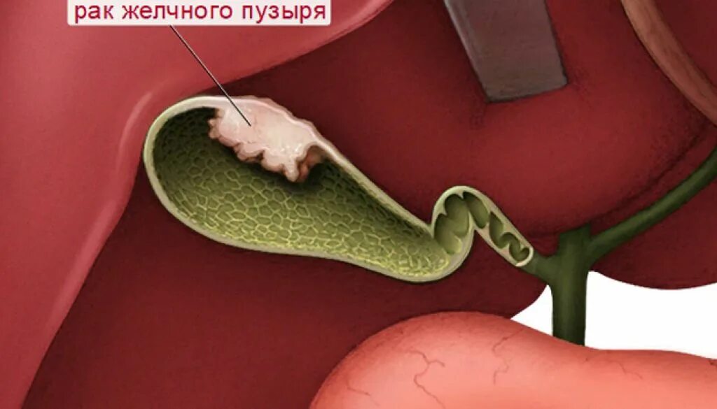 Пузыре симптомы. Раковые опухоли в желчном пузыре. желчный пузырь сокращен. доброкачественные опухоли желчного пузыря.