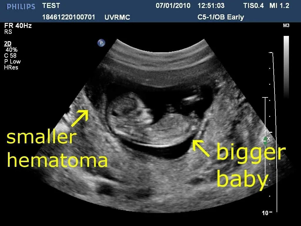 14 недель триместр. Ретрохориальная гематома на 12 неделе беременности. Гематома в матке при беременности 12 недель.
