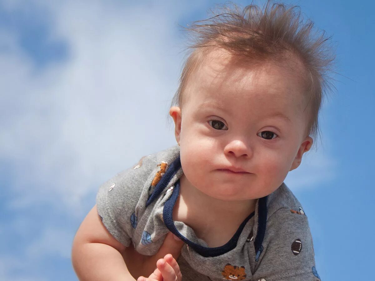 внешние проявления олигофрении. умственная отсталость. умтсенное остлаые детиэ. дети с умственной отсталостью. умственно отсталые дошкольники.