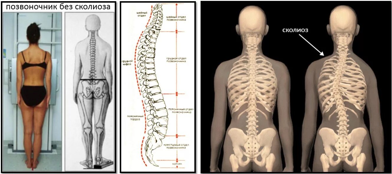 Нормальная поясница. Сколиоз грудного отдела 1 степени отдела. Сколиоз грудо-поясничного отдела позвоночника 1 степени. Сколиоз детский 1 степень. Искривление позвоночника сколиоз 1 стадия.