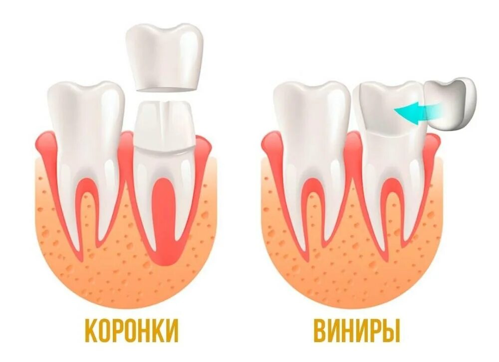 Почему зубы отличаются между собой. Отличие винир от коронок ъ.