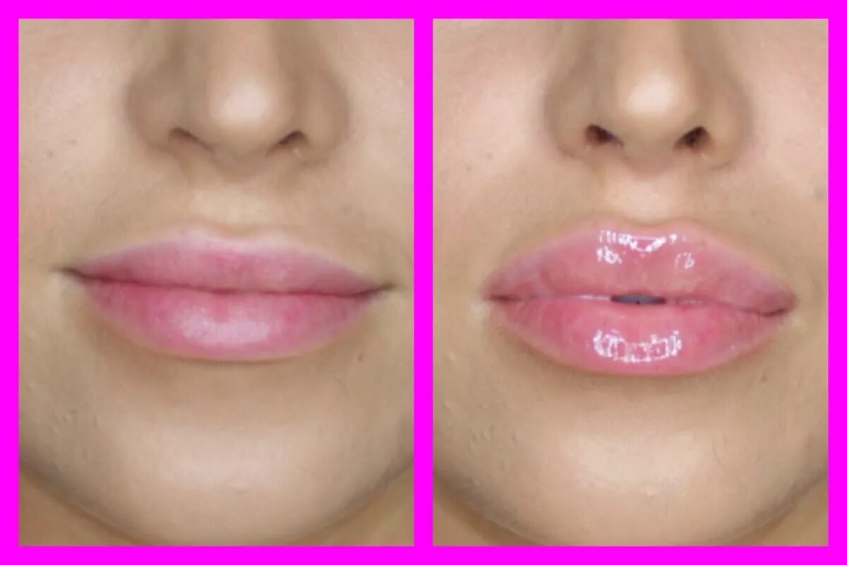 Увеличение губ lips. Увеличенные губы красивые. Красивая форма губ.