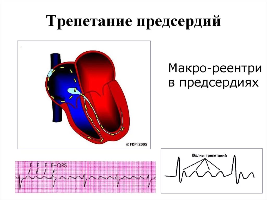 Трепетание предсердий профилактика. Трепетание предсердий регулярная. Трепетание предсердий сердца. Фибрилляция и трепетание предсердий на экг отличия. Правильная форма трепетания предсердий на экг.