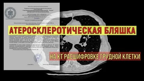 Кальцинированные бляшки