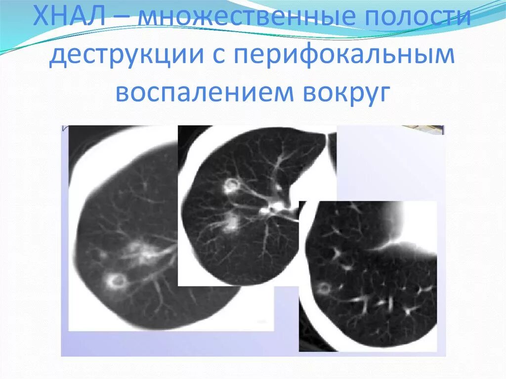 Без перифокальной реакции. Аспергиллома легких на кт. Пневмомикоз на кт пневмомикоз. Пневмомикозы легких классификация.