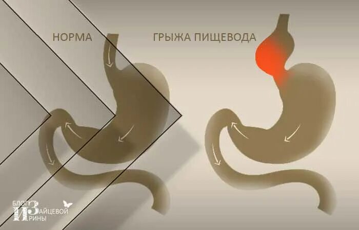 От грыжи пищевода лекарства. Диета при грыже пищеводного отверстия.