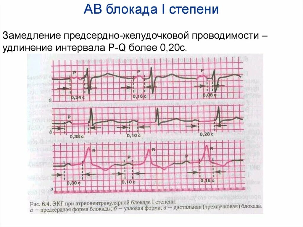 Блокада на первом. ЭКГ при АВ блокаде 1 степени. АВ блокада 1 степени на ЭКГ. А-В блокада 1 степени на ЭКГ. ЭКГ критерии АВ блокады 1 степени.