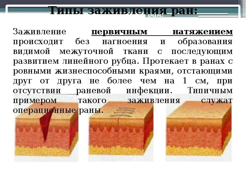 Через сколько заживает рана. Заживление раны первичным натяжением. Заживление первичным натяжением этапы.