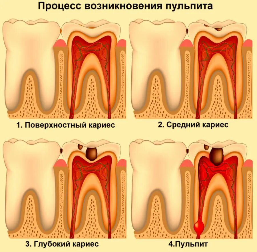 Что делать после лечения зуба. Пульпит 2 канального зуба.