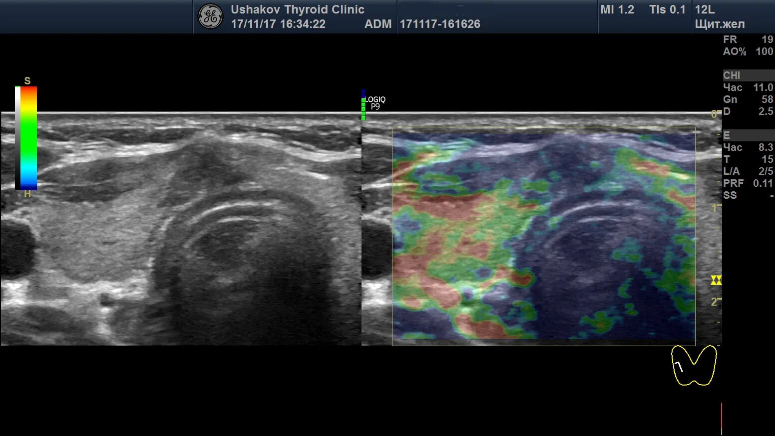 Ультразвуковая компрессионная эластография. Компрессионная эластография щитовидной железы. Что такое эластография узлов щитовидной. УЗИ эластография щитовидной железы.