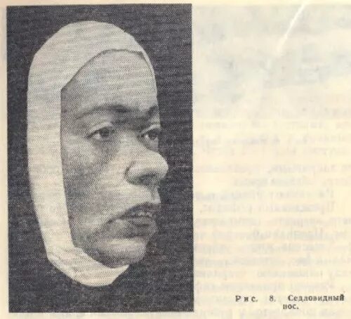 Диффузная папулезная инфильтрация гохзингера. Седловидный нос при сифилисе. диффузная инфильтрация гохзингера. седловидный нос третичный сифилис. инфильтрация кожи гохзингера.
