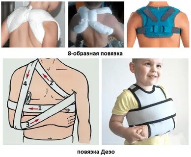 Шины для перелома ключицы у детей