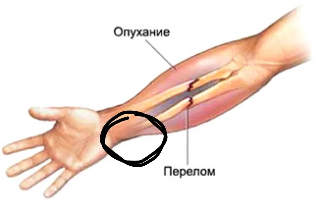 Повреждение предплечья и кисти