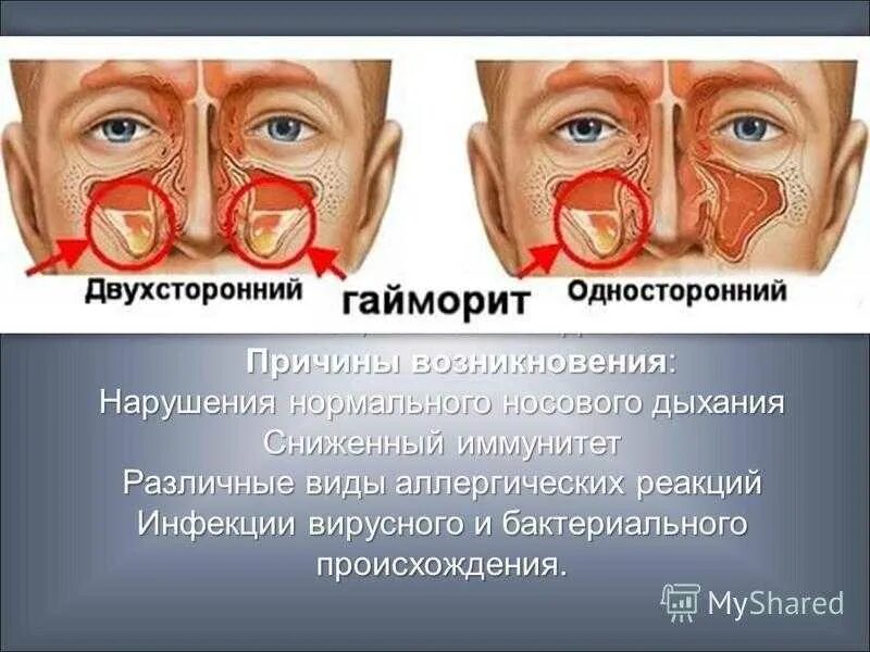 Причины заболевания носа. Гайморит симптоматика. Хронический гайморит симптомы.