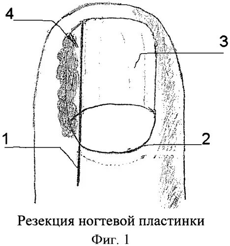 Ногтевая пластика. Краевая резекция ногтя. Краевая резекция ногтевой пластинки. Клиновидная резекция вросшего ногтя. Вросший ноготь операция Шмидена.