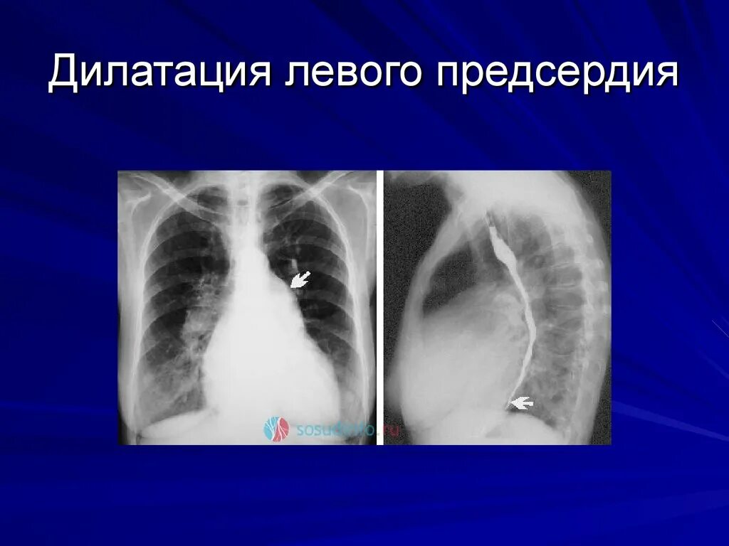 Рентген при митральной недостаточности. Рентгенологическое исследование сердца. Дилатация левого предсердия. Дементация левого предсердия. Дилатация полостей предсердий