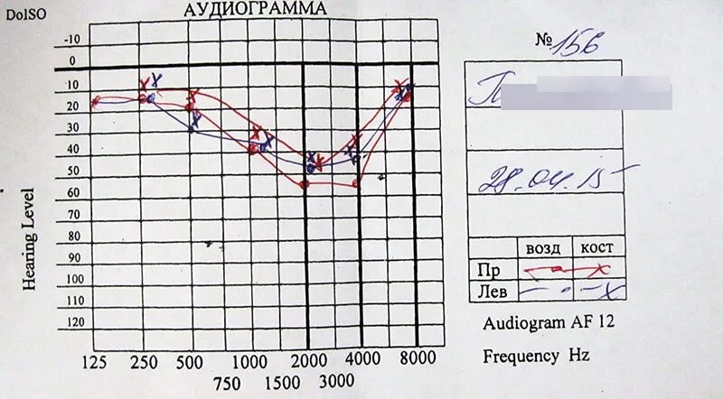 Аудиограмма норма. Аудиометрия слуха норма таблица. Тональная пороговая аудиограмма норма. Аудиометрия слуха расшифровка таблица норма. Аудиограмма здорового человека норма.