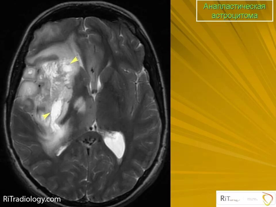 Анапластическая астроцитома головного мозга. Опухоль головного мозга астроцитома. Диффузная астроцитома