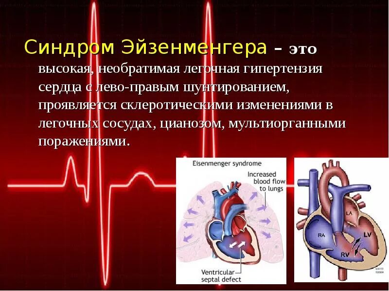 Синдром Эйзенменгера гемодинамика. Синдром Эйзенменгера клинические проявления. Вторичный комплекс Эйзенменгера. Дефект межжелудочковой перегородки синдром Эйзенменгера.